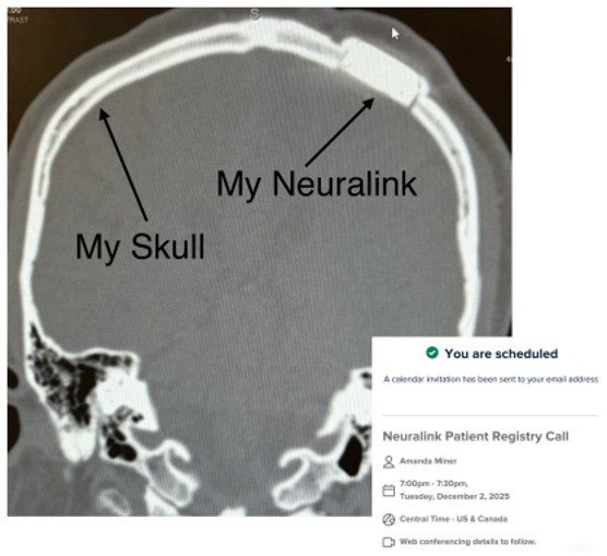 CT scan from CJ Johnson's 30-day visit showing his Neuralink implant in the skull